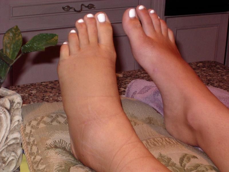 Le blog des filles en béquilles